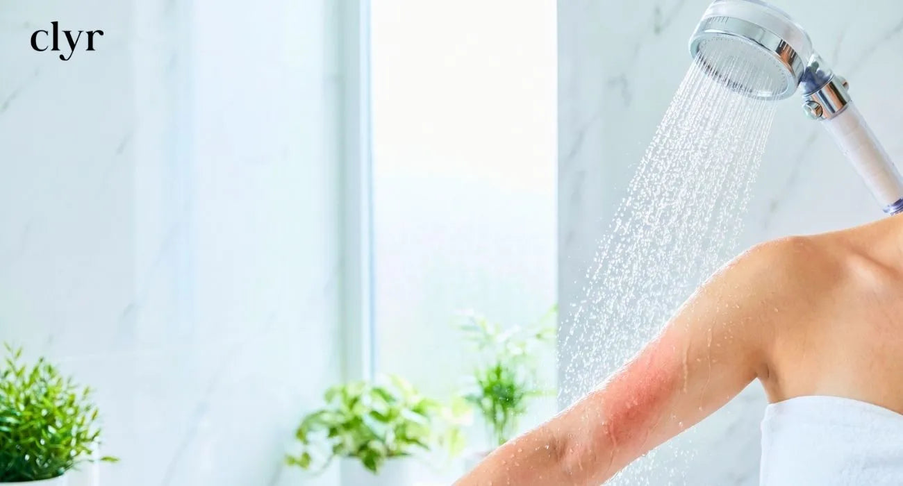 Does a Shower Filter Help with Eczema and Skin Flare Ups